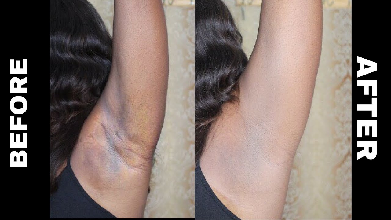 How To Get Rid Of Underarm Skin Darkening