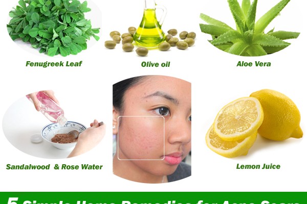 Five simple and effective home remedies for acne scars