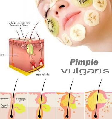 Home Remedies That Helps To Get Rid Of Pimples Easily