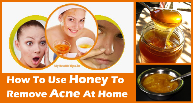 Honey for Acne