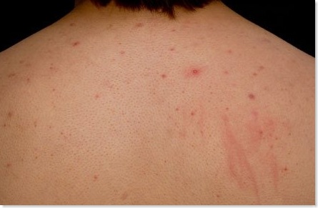 How To Get Rid Of Back Acne