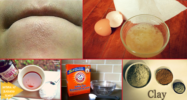 How To Get Rid Of Blackheads Fast