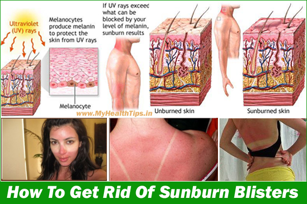 How To Get Rid Of Sunburn Blisters