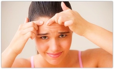 How To Prevent Pimples Due To Dandruff