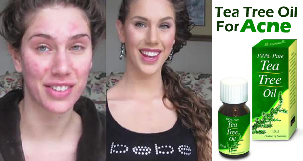 How To Use Tea Tree Oil for Acne