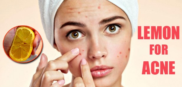 How to Use Lemon for Acne Removal