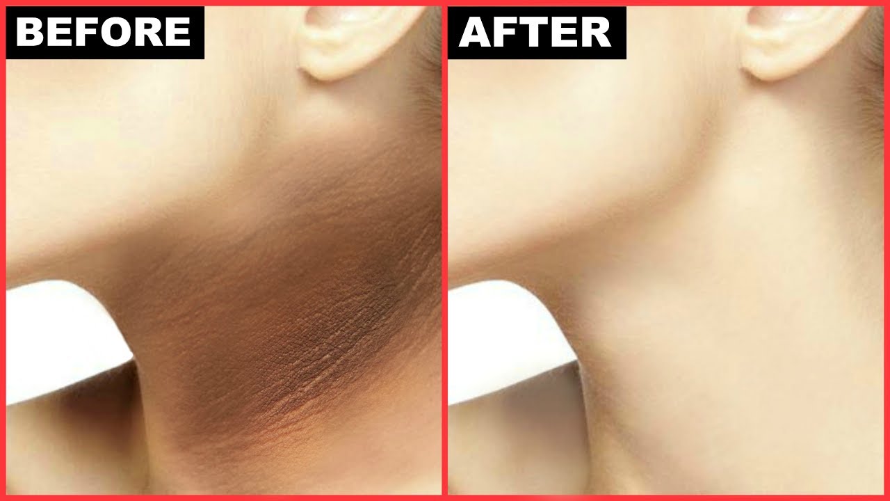 Some Of The Best Home Remedies To Get Rid Of Dark Neck