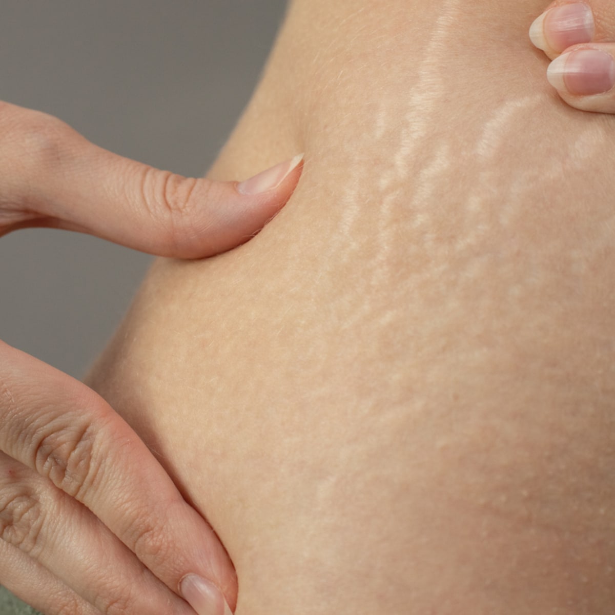 Home Remedies For Stretch Marks That Work Surprisingly Well